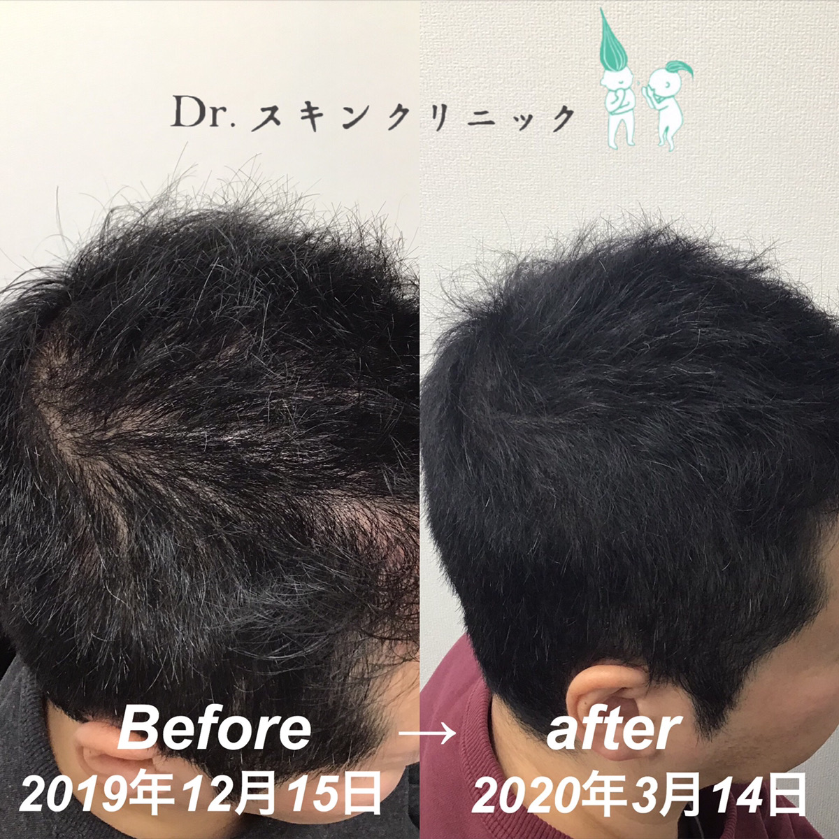 側頭部before After Dr Agaクリニック 公式ブログ