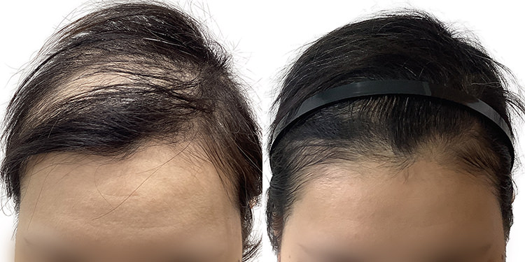 28歳 女性 症例 3ヶ月目