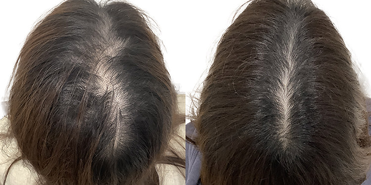 28歳 女性 症例 3ヶ月目