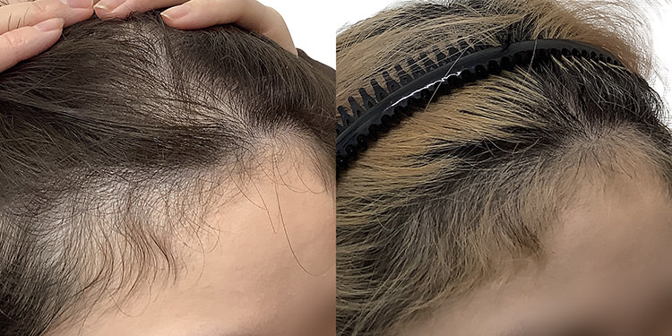 27歳 女性 症例 4ヶ月目