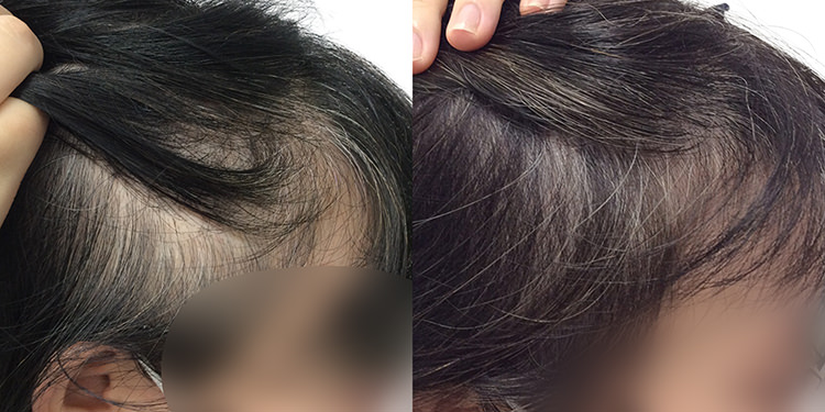 37歳 女性 症例 3ヶ月目