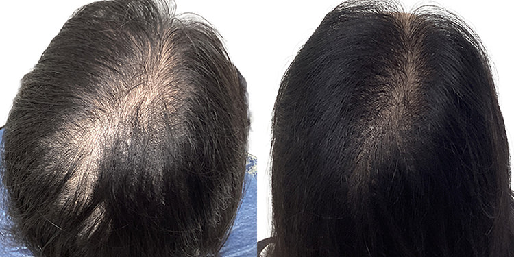 30歳 女性 症例 4ヶ月目