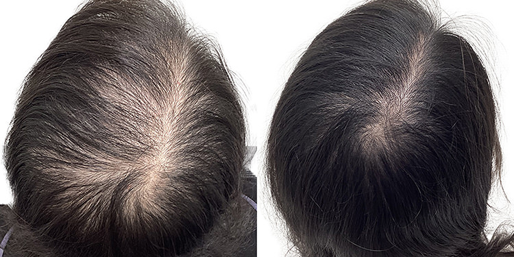 39歳 女性 症例 6ヶ月目