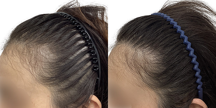 38歳 女性 症例 7ヶ月目