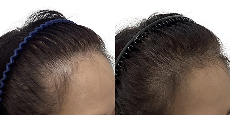 47歳 女性 症例 3ヶ月目