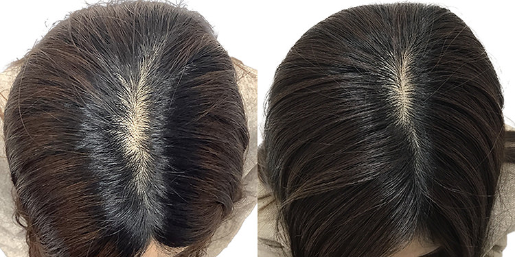 40歳 女性 症例 3ヶ月目