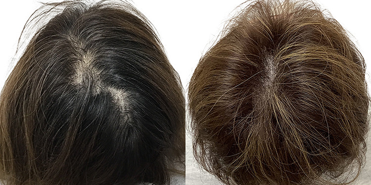 43歳 女性 症例 4ヶ月目