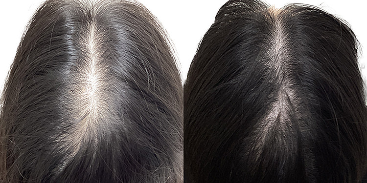 40歳 女性 症例 5ヶ月目