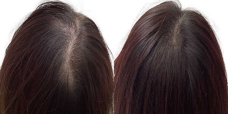 45歳 女性 症例 10ヶ月目