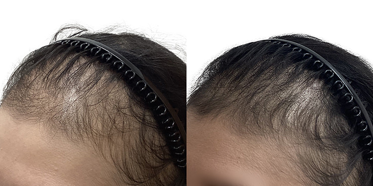 50歳 女性 症例 3ヶ月目