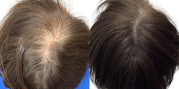 55歳 女性 症例 3ヶ月目