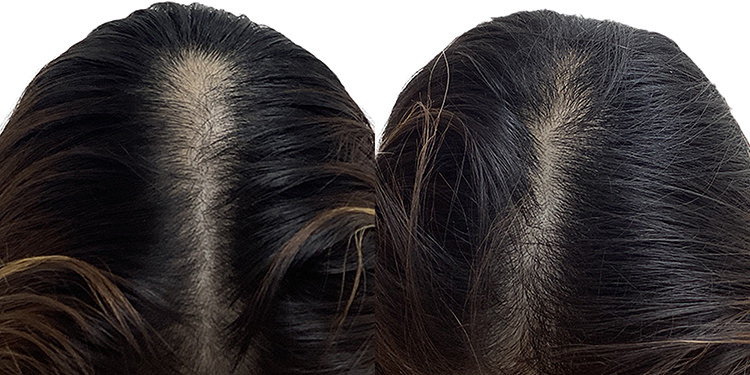 52歳 女性 症例 4ヶ月目