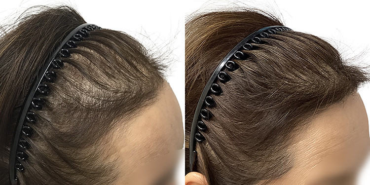 55歳 女性 症例 6ヶ月目