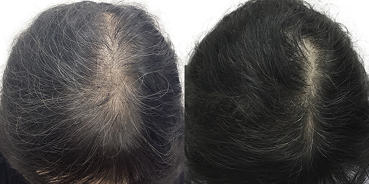 54歳 女性 症例 11ヶ月目