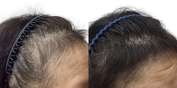 63歳 女性 症例 3ヶ月目