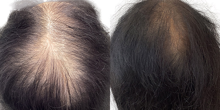 63歳 女性 症例 6ヶ月目