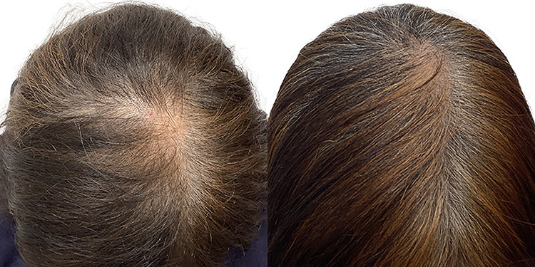 63歳 女性 症例 10ヶ月目