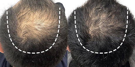 36歳 男性 症例 12ヶ月目